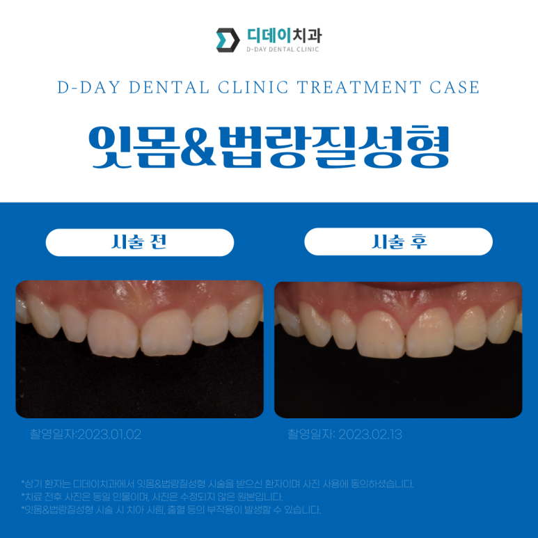 앞니성형? 라미네이트 없이 치아성형하는 방법 관련 이미지 2