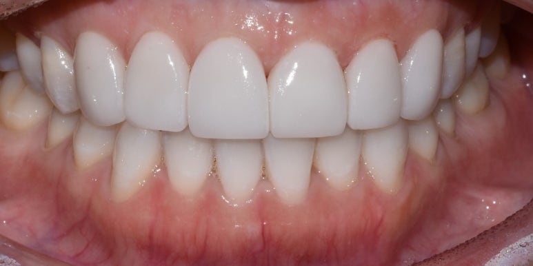 라미네이트치아삭제때문에 고민? 이것 확인하고 결정하세요 관련 이미지 6