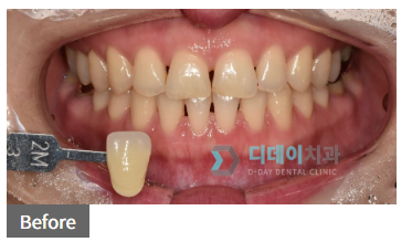 면접 전 치아미백, 꼭 알고 받으세요. 관련 이미지 1