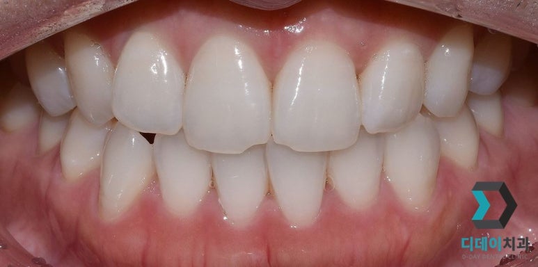 라미네이트교체, 재시술은 더 신중해야 하는 이유? 관련 이미지 1