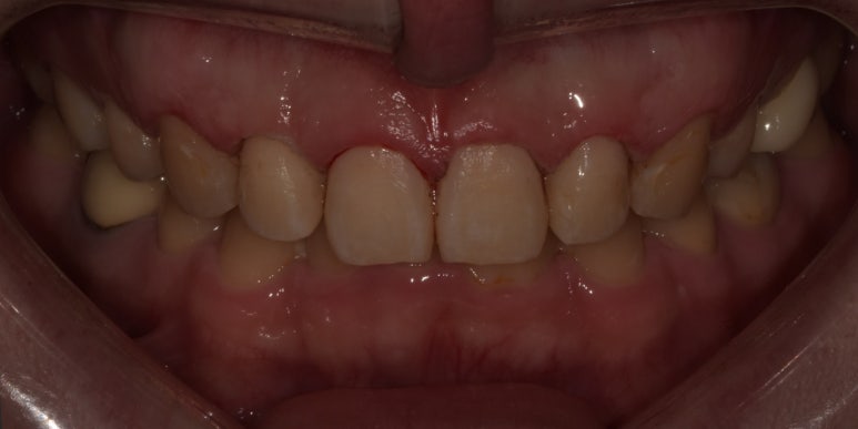 잇몸성형과 잇몸보톡스, 어떤 차이가 있는걸까요? 관련 이미지 8