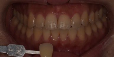 치과미백비용? 효과? A 부터 Z까지 탈탈 털어 알려드립니다. 관련 이미지 10