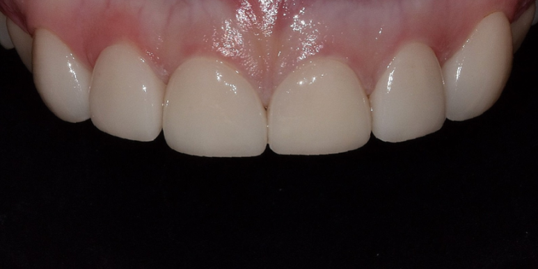 라미네이트 전후 비교, 주의사항, 비용까지 총정리 관련 이미지 4