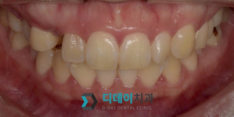 법랑질성형, 라미네이트와 어떻게 다른가요 관련 이미지 3