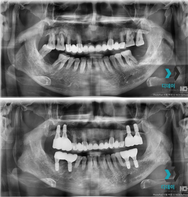 언주역치과, 임플란트 실력 있는 곳은 이 2가지에서 확 차이납니다 관련 이미지 7