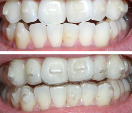 강남역교정치과 너무 많죠? 이 2가지면 실력있는 곳 찾을 수 있습니다 관련 이미지 6