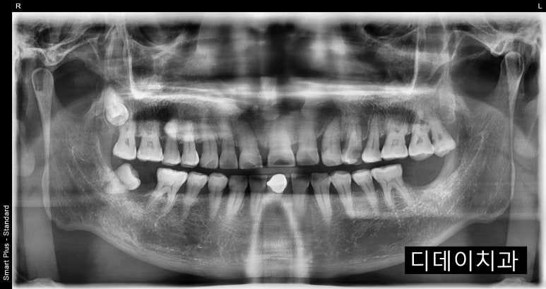 임플란트치아보험, 이렇게 하면 보장 못받을 수도 있습니다. 관련 이미지 2