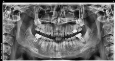 잇몸에혹? 물집? 원인과 치료방법 자세히 설명해 드립니다. 관련 이미지 2