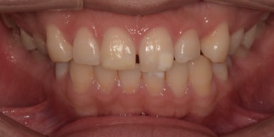 라미네이트 전후사진과 치료비용까지 숨김없이 알려드립니다. 관련 이미지 4