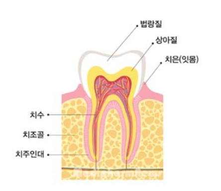 도곡동 충치치료,이에 까만 점이 보인다면? 관련 이미지 2