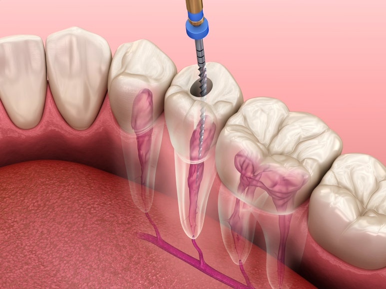 충치치료 기간, 과정, 비용까지 전문의가 알려드립니다. 관련 이미지 14
