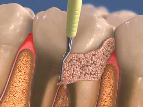 강남 치주잇몸소파술 치과, 손해 보기 싫다면? 관련 이미지 7