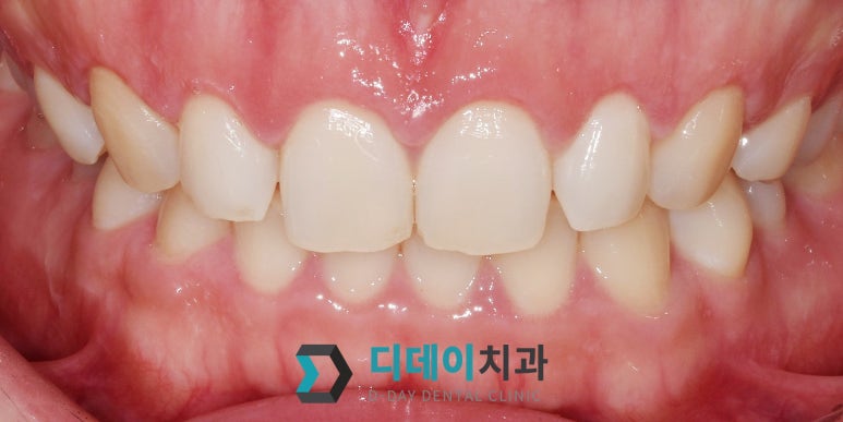 웃을 때 잇몸이 많이 보인다면, 몰라서 못하는 이것 관련 이미지 12