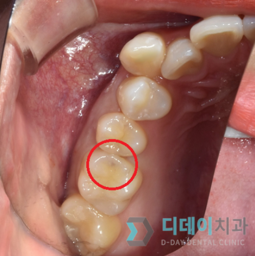 강남충치치료? 티 안나는 "인레이" 치료 사례 관련 이미지 1