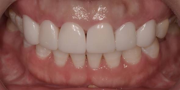 잇몸성형후기, 사례가 없어 고민하셨던 분만 관련 이미지 12