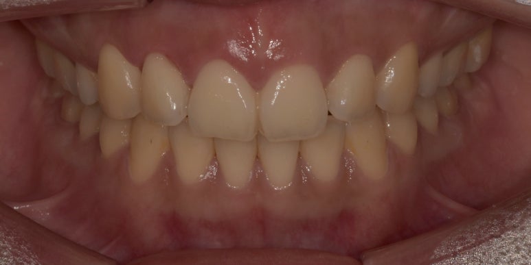 잇몸성형, OO해서 후회해요&hellip; 후회하는 이유는? 관련 이미지 6