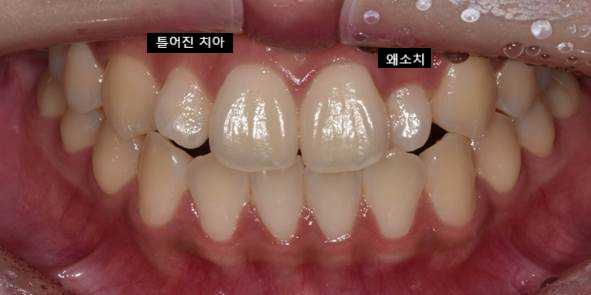 작은이빨, 왜소치? 치아 크기를 키우고 싶은 분만 <필독> 관련 이미지 16