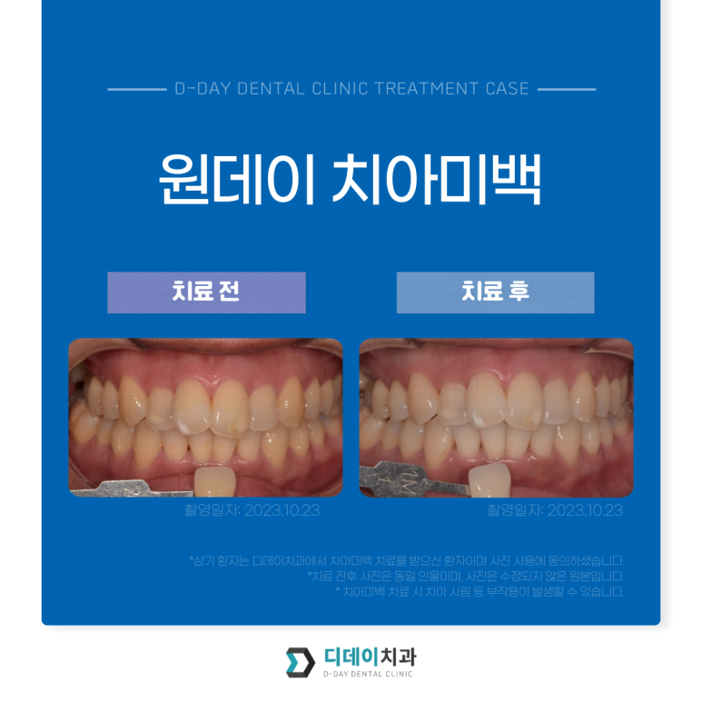 치아미백비용, 치과가 10배 비싼데도 시술하는 이유? 관련 이미지 6