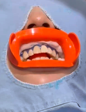 선릉역치아미백 리뷰 보기 전에 관련 이미지 6