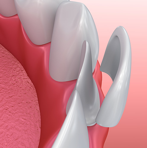 무삭제 라미네이트, 장점과 단점 전문의가 설명드립니다. 관련 이미지 6