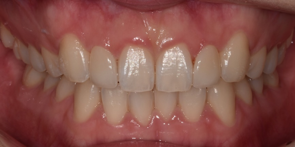 라미네이트, 치아보험 적용이 가능할까요? 관련 이미지 10