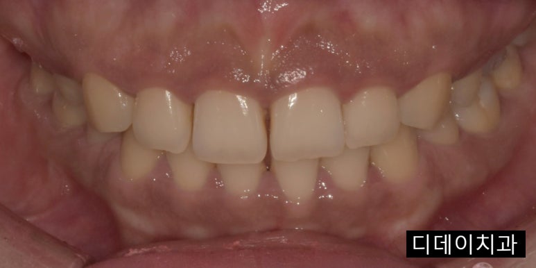 [진심인터뷰] &ldquo;잇몸성형, 안 할 이유가 1도 없어요&rdquo; 예비신부의 후기 관련 이미지 2