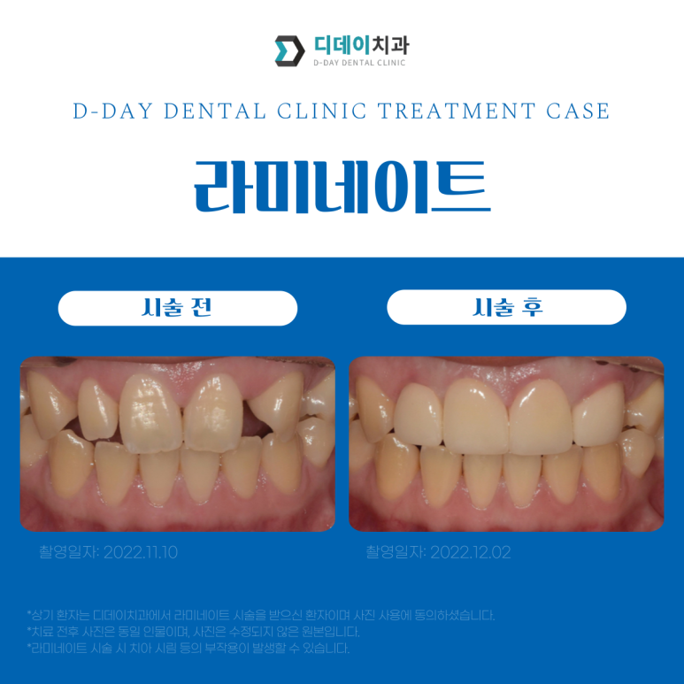 강남라미네이트 잘하는 곳 선택법, 치과의사가 알려드립니다. 관련 이미지 6