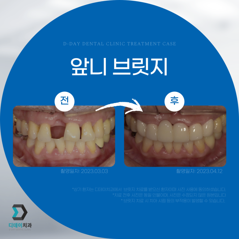앞니브릿지교체? 브릿지를 크라운으로 교체 가능할까? 관련 이미지 3