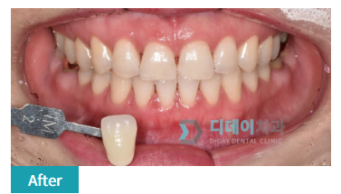 면접 전 치아미백, 꼭 알고 받으세요. 관련 이미지 2