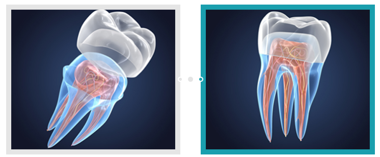 신경치료크라운 꼭 해야할까요? 관련 이미지 2
