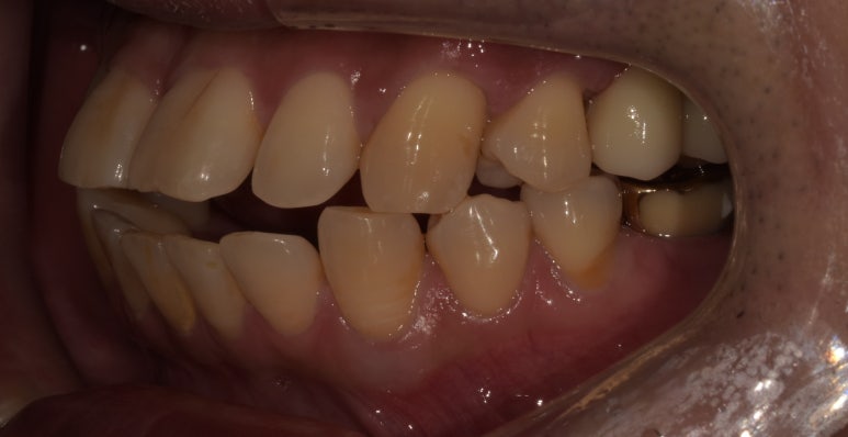 상악동거상술과 뼈이식임플란트 실제 치료사례로 보여드립니다. 관련 이미지 11