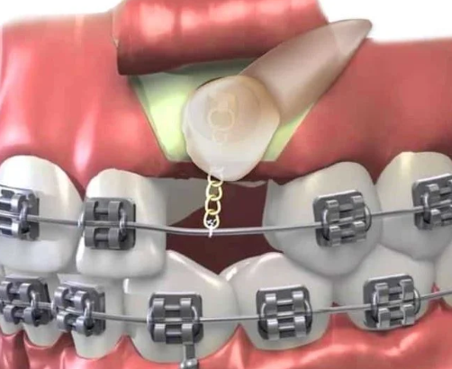 삼성역 치과 투명교정, 일반교정과 뭐가 다른지 정리해드립니다 관련 이미지 6