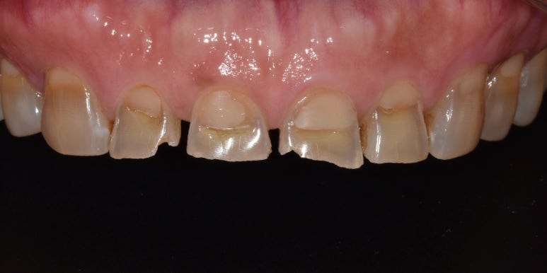 라미네이트올세라믹, 차이점과 치료사례까지 모두 공유합니다. 관련 이미지 5