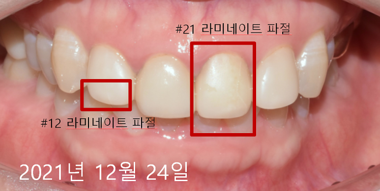 라미네이트 주의사항? 잘못 시술되면 이런 부작용 옵니다... 관련 이미지 6