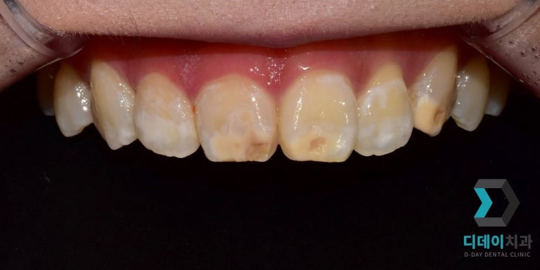 라미네이트후기, 치료사례만 모아 보여드립니다 관련 이미지 11