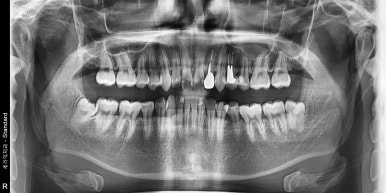 임플란트치아보험, 이렇게 하면 보장 못받을 수도 있습니다. 관련 이미지 5