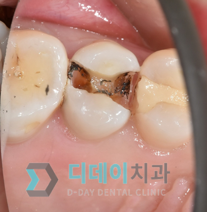 신경치료크라운 꼭 해야할까요? 관련 이미지 3