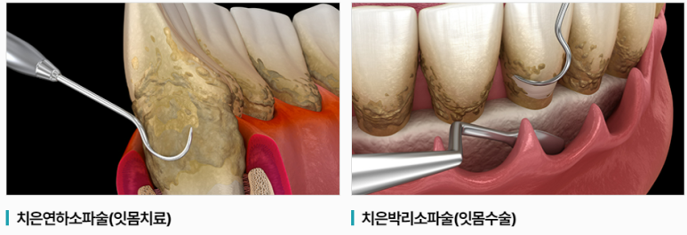 치아결손 시 암 위험 증가? 구강내 염증의 엄청난 나비효과 관련 이미지 6