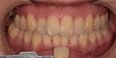 웨딩촬영치아미백? 자신있게, 환하게 웃을 수 있는 꿀팁 관련 이미지 7