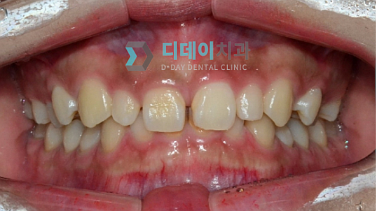 벌어진치아, 교정하지 않고 앞니틈새를 메우는 방법 관련 이미지 3