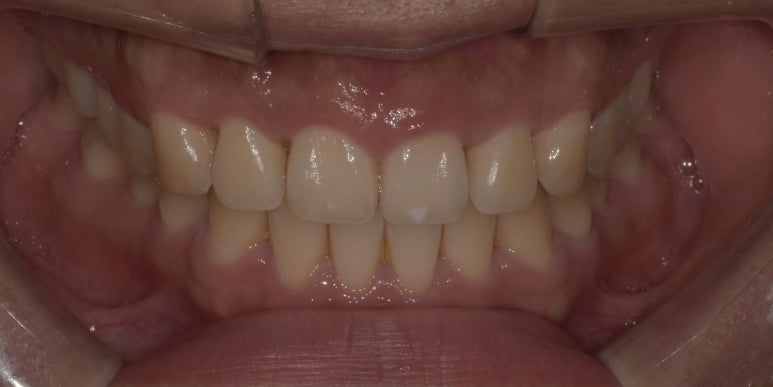 잇몸성형과 잇몸보톡스, 어떤 차이가 있는걸까요? 관련 이미지 9