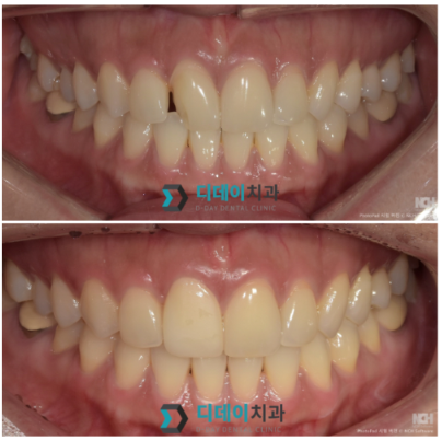언주역치과추천 라미네이트, 자연치아 삭제량이 중요합니다 관련 이미지 4