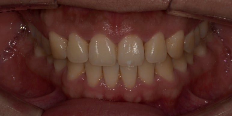 잇몸성형과 잇몸보톡스, 어떤 차이가 있는걸까요? 관련 이미지 10