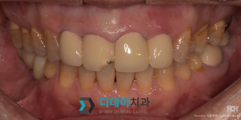 지르코니아크라운가격 차이? 의사가 직접 설명하는 3가지 기준 관련 이미지 4