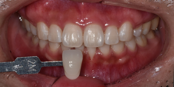 치아미백유지기간부터 종류, 주의사항까지 알려드립니다 관련 이미지 9