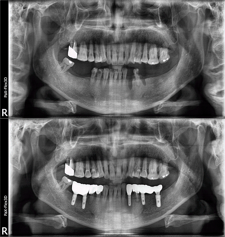역삼역 치과, 내게 꼭 맞는 치료를 위한 선택법 관련 이미지 6