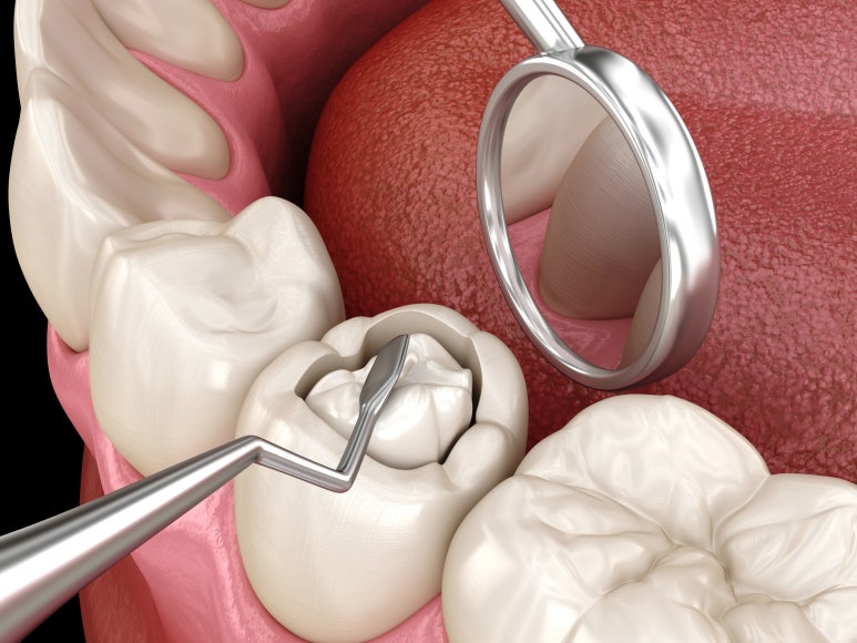 인레이통증? 치료 후 3일 이상 계속되는 분은 보세요. 관련 이미지 1
