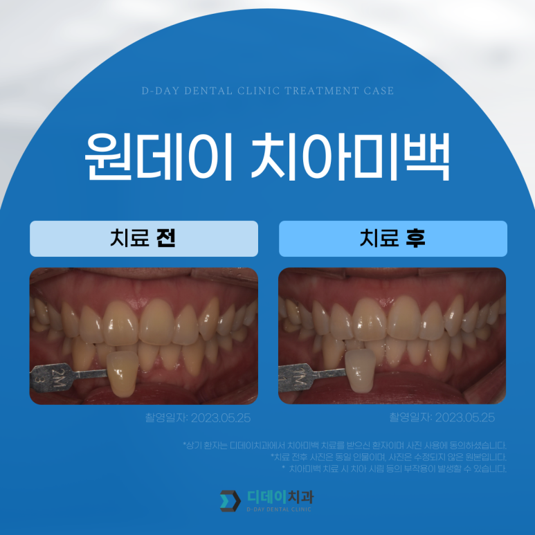 웨딩촬영치아미백? 자신있게, 환하게 웃을 수 있는 꿀팁 관련 이미지 12