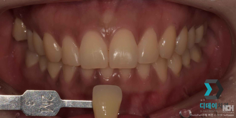 치아미백후기 믿으면 안 되는 이유? 전문의가 설명드립니다. 관련 이미지 6