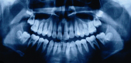 50대 이후 임플란트, 더 기다리면 안되는 이유 정확히 알려드립니다. 관련 이미지 5